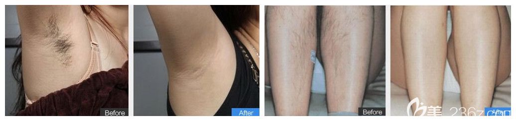 相山時(shí)光腋窩+小腿脫發(fā)案例效果對(duì)比照片