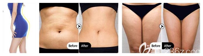 時(shí)光吸脂腰腹+大腿吸脂及臀部脂肪填充案例效果對(duì)比