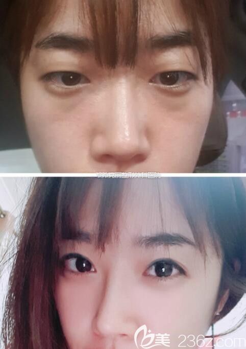 韓國(guó)?？他愙w鏞瑾雙眼皮真人案例