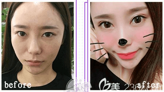 北京紫潔儷方埋線雙眼皮案例