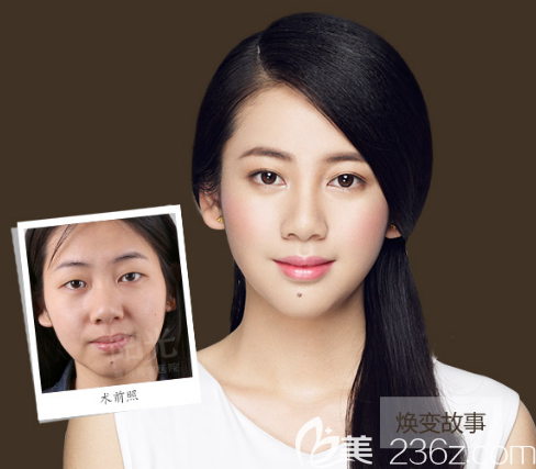 整形醫(yī)院李鵬醫(yī)生雙眼皮案例