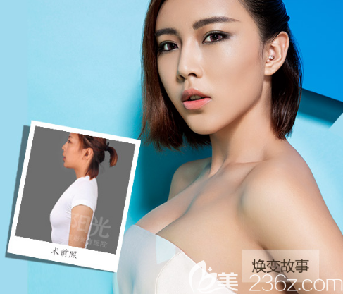 整形醫(yī)院李映雨院長隆胸案例