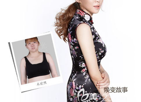 整形醫(yī)院陳星光全身吸脂案例