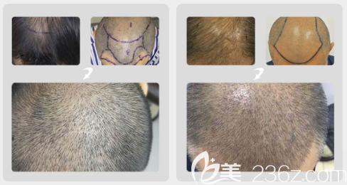 整形醫(yī)院楊浩東頭發(fā)種植案例