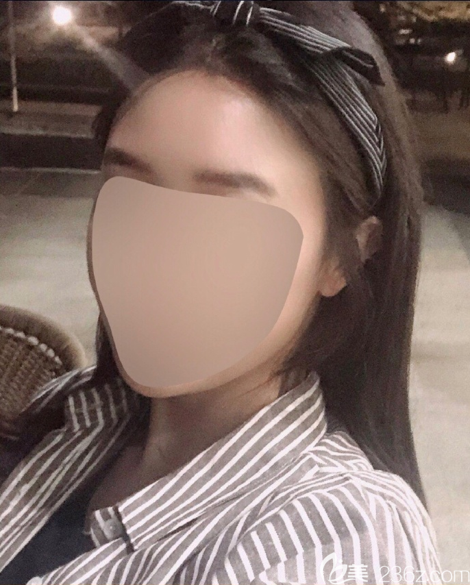 韓國芭堂旻長煥額頭縮小感覺縮小了很多疤痕很細(xì)，總之滿意推薦