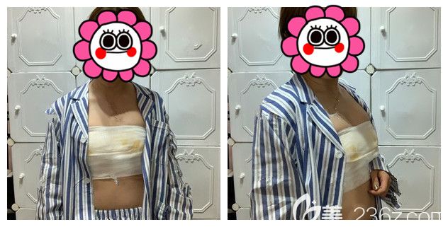 剛做完自體脂肪隆胸術(shù)后即刻效果 剛做完自體脂肪隆胸術(shù)后即刻效果