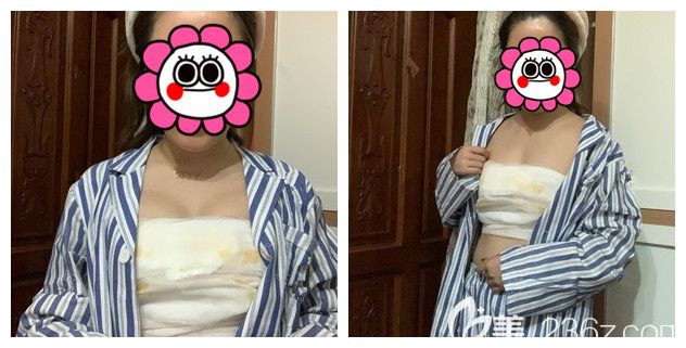 術(shù)后四天自體脂肪隆胸恢復(fù)情況 術(shù)后四天自體脂肪隆胸恢復(fù)情況