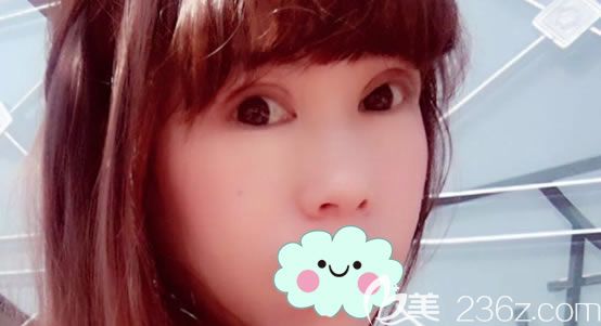 做完雙眼皮修復手術3天恢復效果