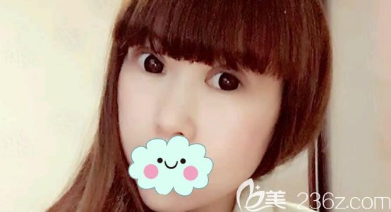 寧波雅韓做失敗雙眼皮修復案例