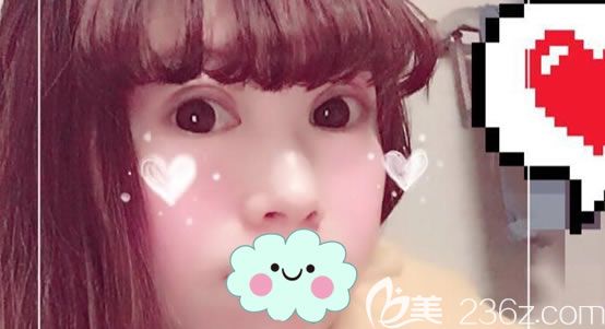 寧波雅韓龔濤做雙眼皮失敗修復案例