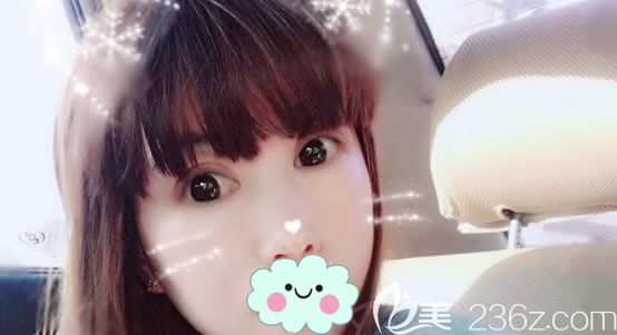 3個(gè)月前在寧波雅韓做了上眼瞼去脂手術(shù)修復(fù)前一次做失敗不對(duì)稱的雙眼皮，現(xiàn)在放效果啦