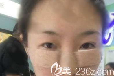 寧波建國整形剛做完去眼袋圖片