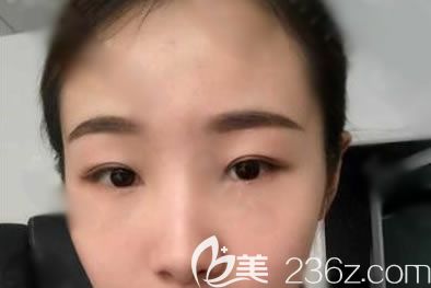 在寧波建國醫(yī)美做外切去眼袋的我給大家整理一份祛眼袋攻略,去眼袋真是越早越好喲