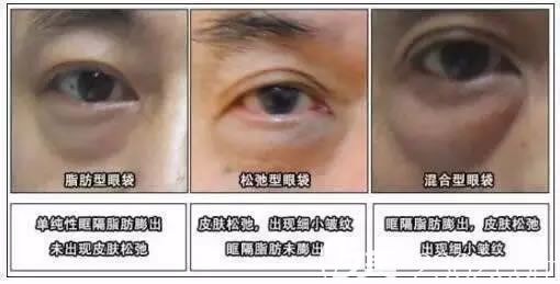 怎么去眼袋的詳細攻略