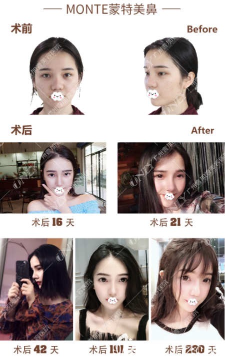 廣州壹加壹李明做的肋軟骨隆鼻實例療效 廣州壹加壹李明做的肋軟骨隆鼻實例療效