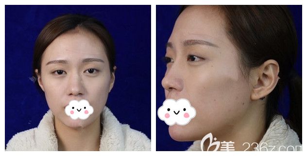面診<!--<i data=20240703-sp></i>-->術(shù)前單眼皮塌鼻子 面診<!--<i data=20240703-sp></i>-->術(shù)前單眼皮塌鼻子