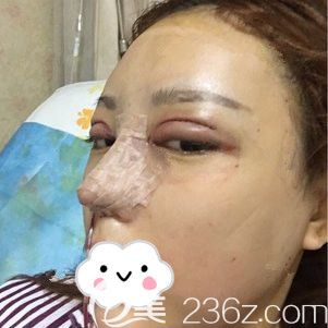 剛做完眼鼻綜合術(shù)后即刻效果 剛做完眼鼻綜合術(shù)后即刻效果