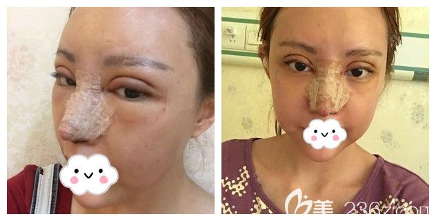 術(shù)后五天眼鼻消腫恢復(fù)的狀態(tài) 術(shù)后五天眼鼻消腫恢復(fù)的狀態(tài)