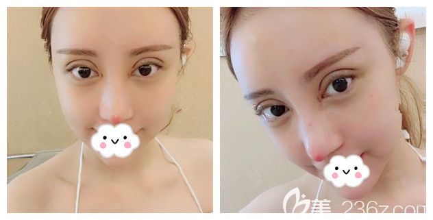 一周拆線后眼鼻恢復(fù)情況 一周拆線后眼鼻恢復(fù)情況