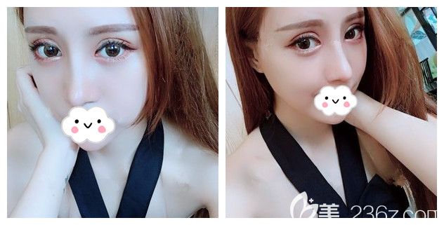 南京眼鼻整形中康美是靠譜的醫(yī)院不?院長主刀案例做10mm眼綜合+鼻綜合術(shù)后效果公開