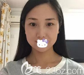 韓鵬醫(yī)生為我注射瘦臉術(shù)后2天微腫