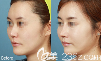 德州友誼隆鼻案例2