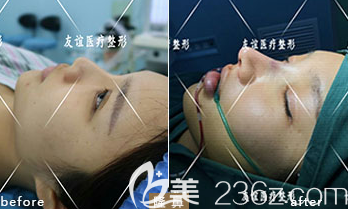 德州友誼隆鼻案例4