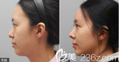 德州天宏假體隆鼻案例3