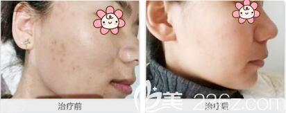 十堰安琪兒做皮秒激光祛斑術(shù)前術(shù)后對(duì)比效果
