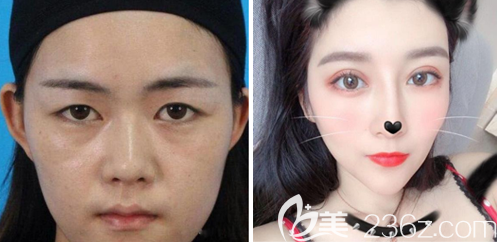 深圳潤澤瑞尼絲劉庚醫(yī)生雙眼皮案例