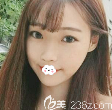 來深圳潤(rùn)澤瑞尼絲做隆鼻術(shù)前照片 來深圳潤(rùn)澤瑞尼絲做隆鼻術(shù)前照片