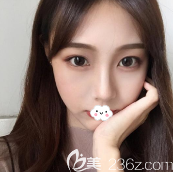 耳軟骨復(fù)合隆鼻術(shù)后10天恢復(fù)效果 耳軟骨復(fù)合隆鼻術(shù)后10天恢復(fù)效果