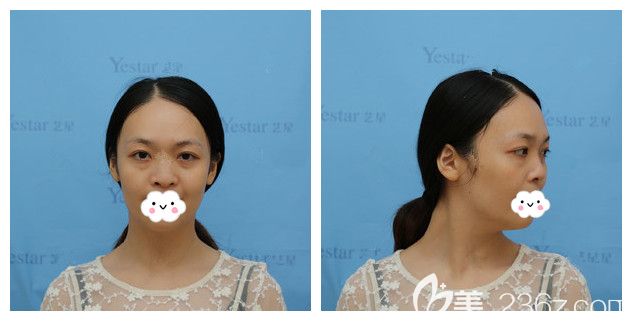 面診南京藝星術(shù)前大眼袋塌鼻子 面診南京藝星術(shù)前大眼袋塌鼻子