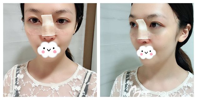 剛做完內(nèi)切去眼袋+假體隆鼻術(shù)后效果 剛做完內(nèi)切去眼袋+假體隆鼻術(shù)后效果