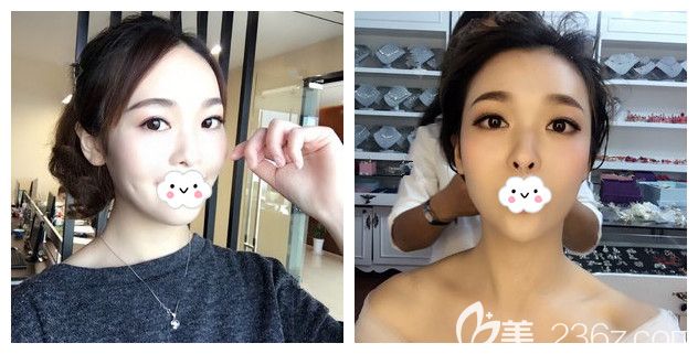 術(shù)后一個(gè)月眼袋和鼻子恢復(fù)情況 術(shù)后一個(gè)月眼袋和鼻子恢復(fù)情況