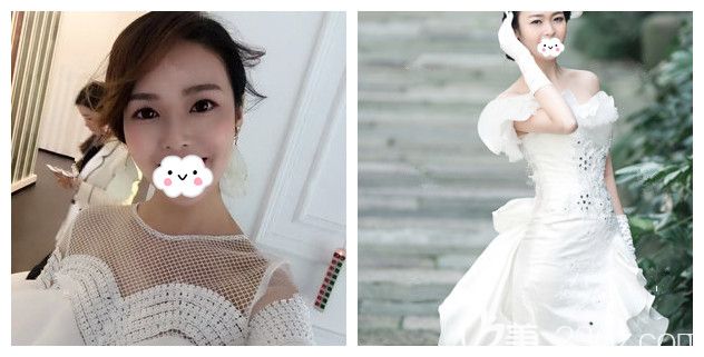 本身就是扇形雙眼皮但卻有顯老眼袋的我到南京藝星做了內切去眼袋+假體隆鼻 術后半年做美麗新娘