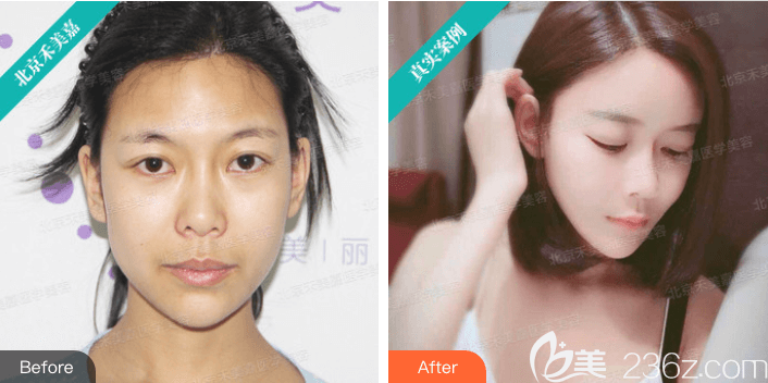 北京禾美嘉任學(xué)會自體脂肪面部填充案例