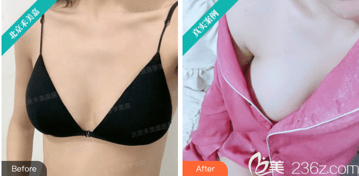 北京禾美嘉任學(xué)會自體脂肪+假體復(fù)合豐胸案例