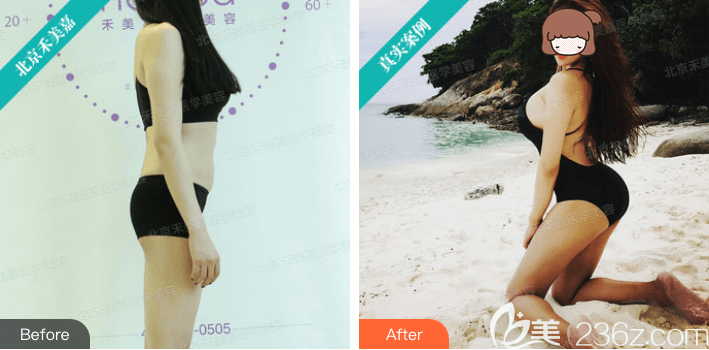 北京禾美嘉任學(xué)會自體脂肪豐臀案例