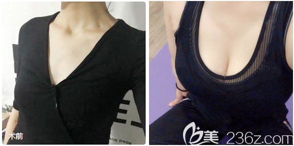 佛山夢(mèng)露游萬福假體隆胸案例前后對(duì)比圖 佛山夢(mèng)露游萬福假體隆胸案例前后對(duì)比圖