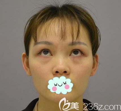 生活習(xí)慣不好導(dǎo)致眼袋提前出現(xiàn) 生活習(xí)慣不好導(dǎo)致眼袋提前出現(xiàn)