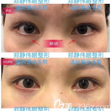 <!--<i data=20240703-sp></i>-->剛做完去眼袋效果 <!--<i data=20240703-sp></i>-->剛做完去眼袋效果