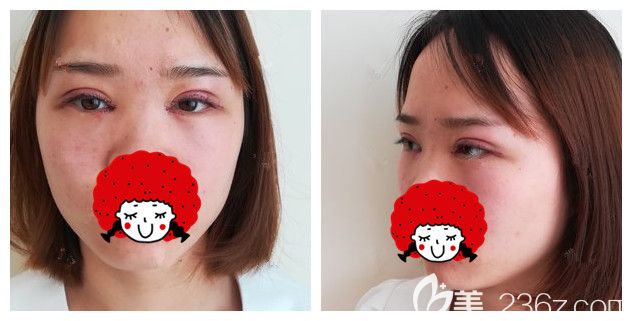 剛做完切開雙眼皮+開內(nèi)眼角綜合