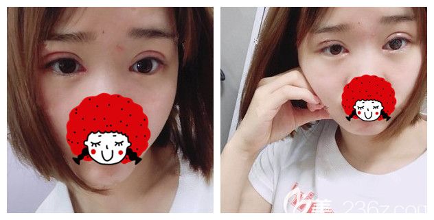 眼綜合一周拆線做激光美膚瘦臉術(shù)后