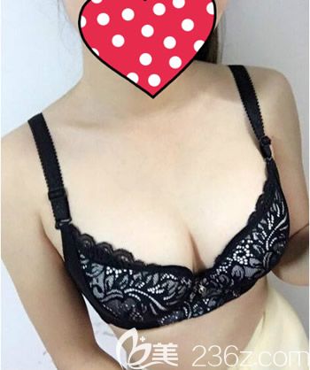 在西寧康華醫(yī)院找<!--<i data=20240703-sp></i>-->做曼托275CC假體隆胸術(shù)后第28天