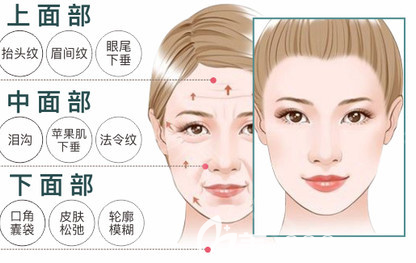 面部下垂的示意圖