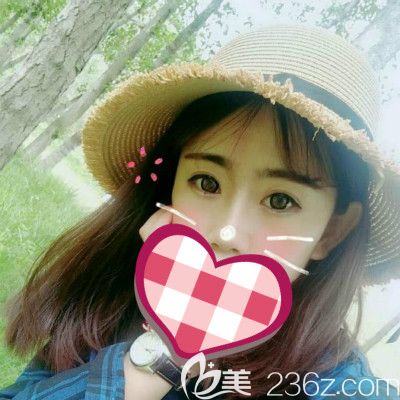 西寧康華醫(yī)院假體+耳軟骨隆鼻案例40天恢復(fù)過程分享 讓大家在隆鼻路上少走彎路