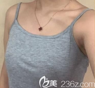 我在玉林華美整形做隆胸術(shù)前 我在玉林華美整形做隆胸術(shù)前