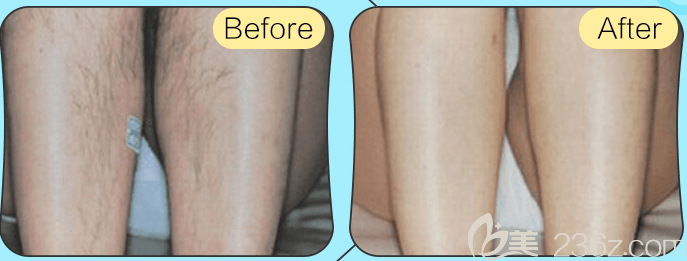 北京藝星脫毛案例