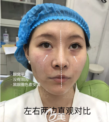 眼周小熨斗術(shù)前術(shù)后<span style= 眼周小熨斗術(shù)前術(shù)后<span style=